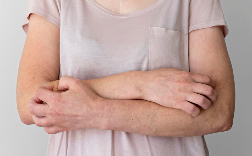 Le CBD pour le psoriasis et l'eczéma : une solution prometteuse ? - HoRuS